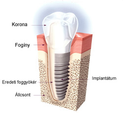 implanttom_vzlat_1